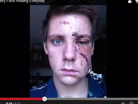 Time-lapse selfie shows subject’s face healing after vicious bar attack