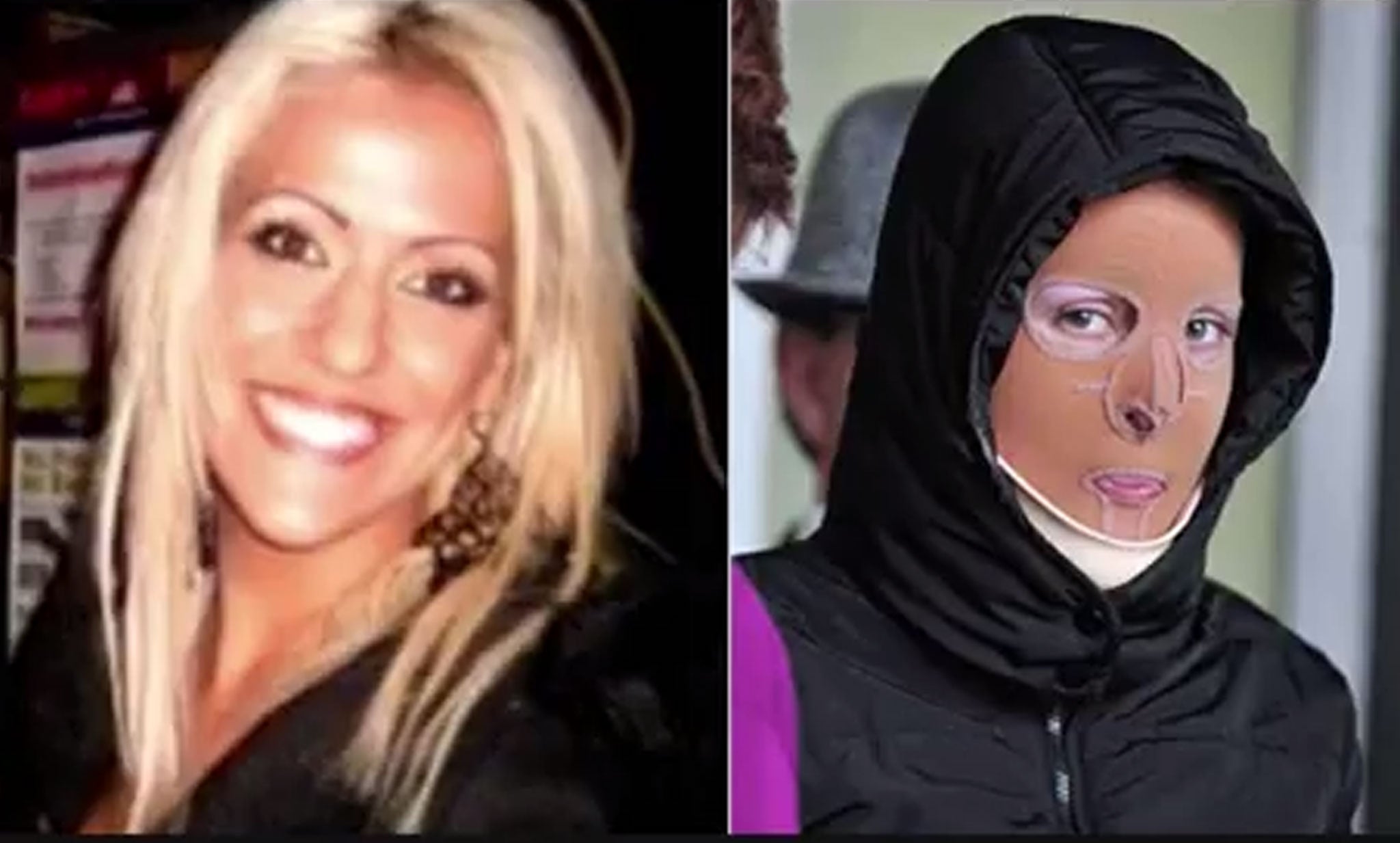 Dana Vulin wearing her protective mask. She underwent 30 months of intensive surgery