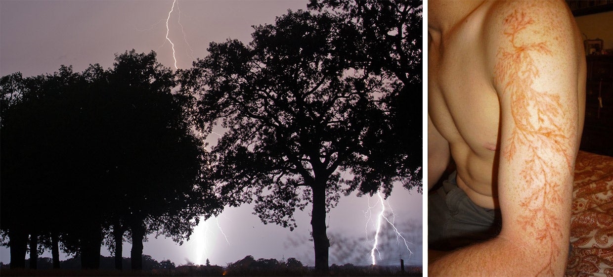 lightning scars black person