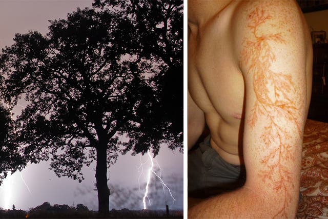 What it's like to be struck by lightning (and survive), The Independent