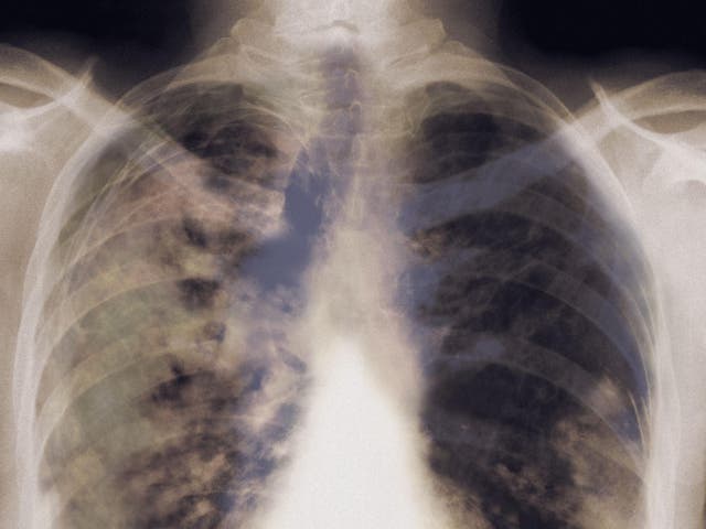Lung cancer has a low rate of survival, with just 10 per cent of patients still being alive five years after diagnosis