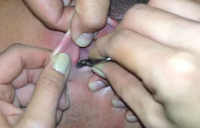 A man had a huge moth extracted from his ear canal - on camera