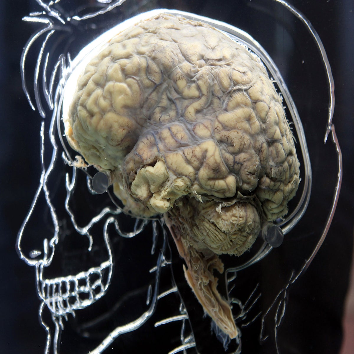 Shell shock solved: Scientists pinpoint brain injury that causes