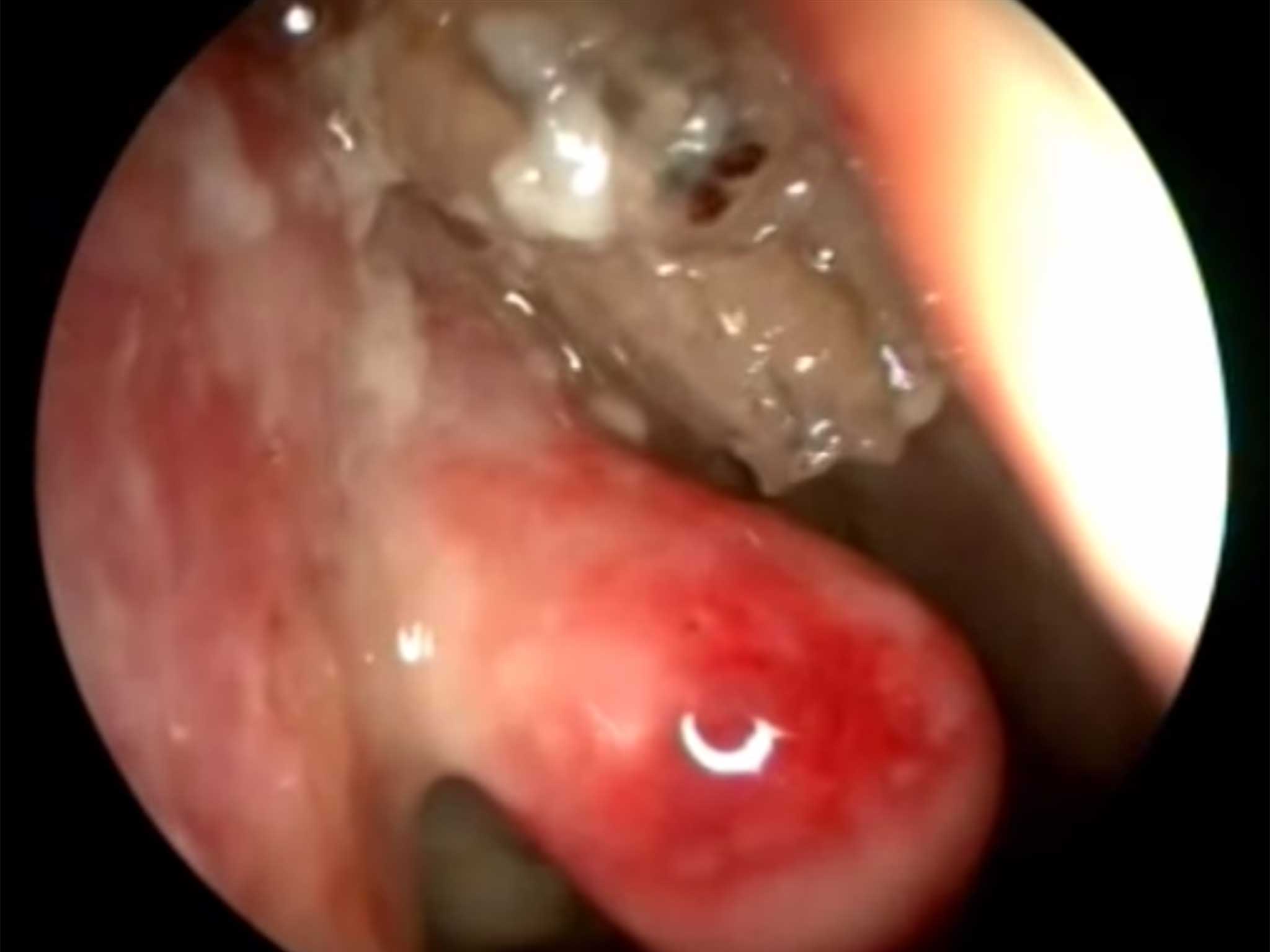 Image from the camera inside the man's nose - the maggots are white