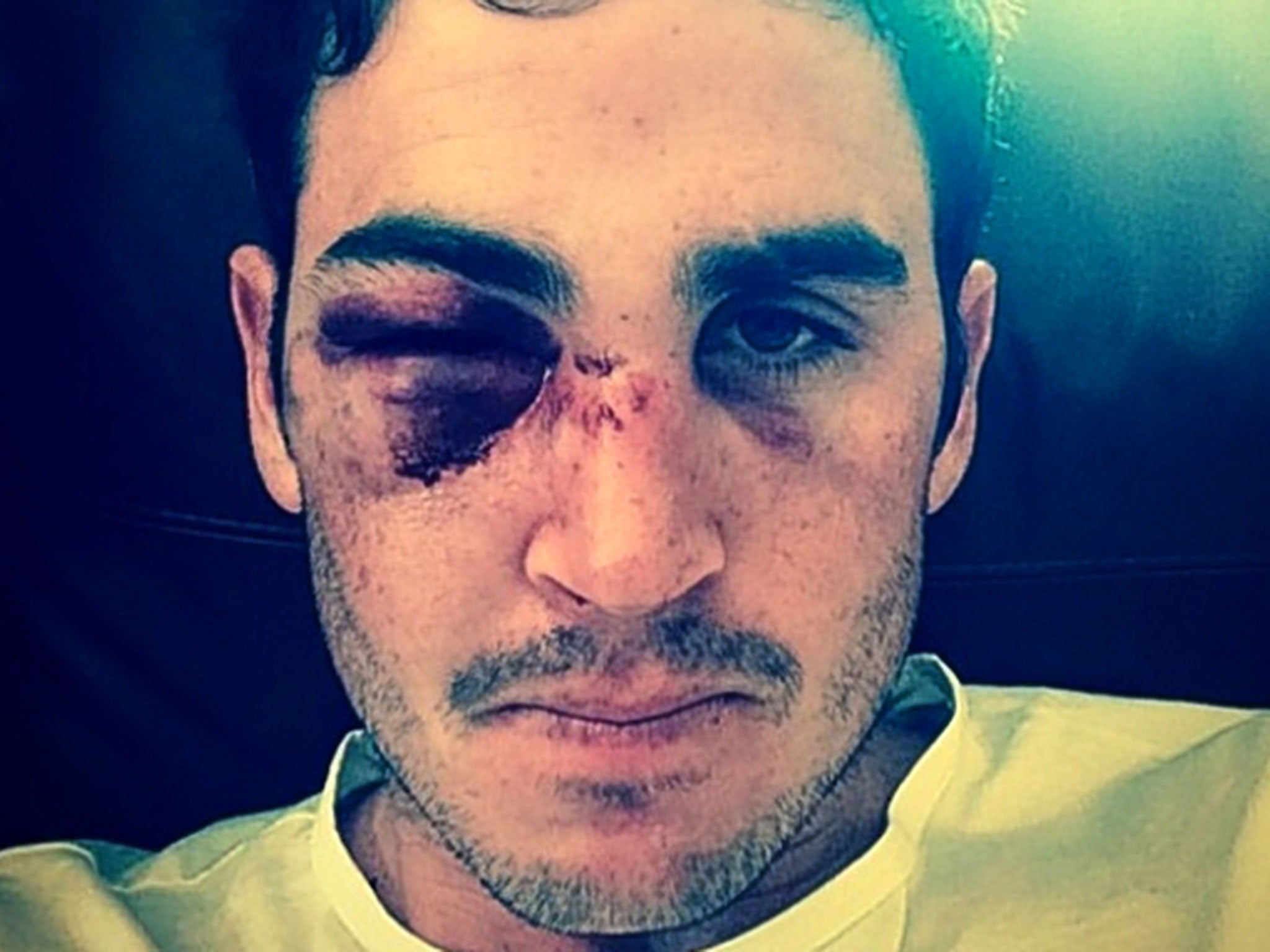 Craig Kieswetter posted this picture of his injury in July