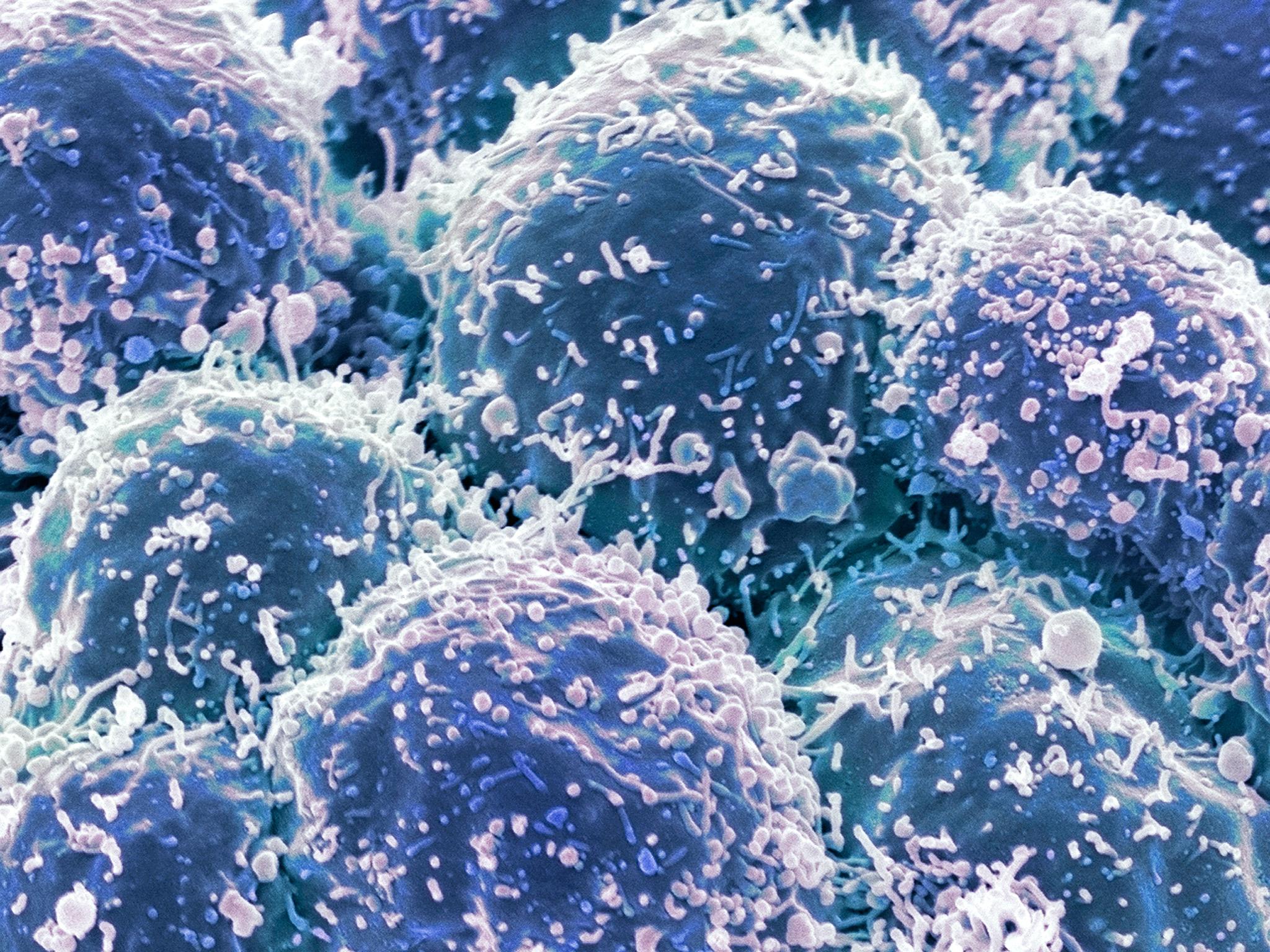 Micrographic view of lung cancer cells