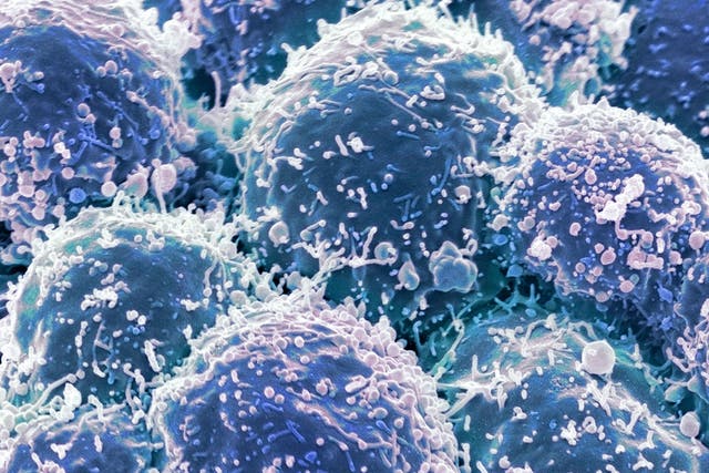 Micrographic view of lung cancer cells