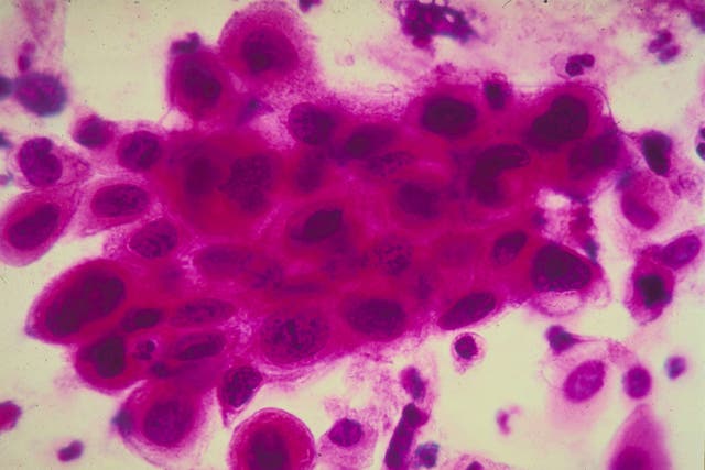 New cervical cancer test for human pappilomavirus will reduce need to look for abnormal cells