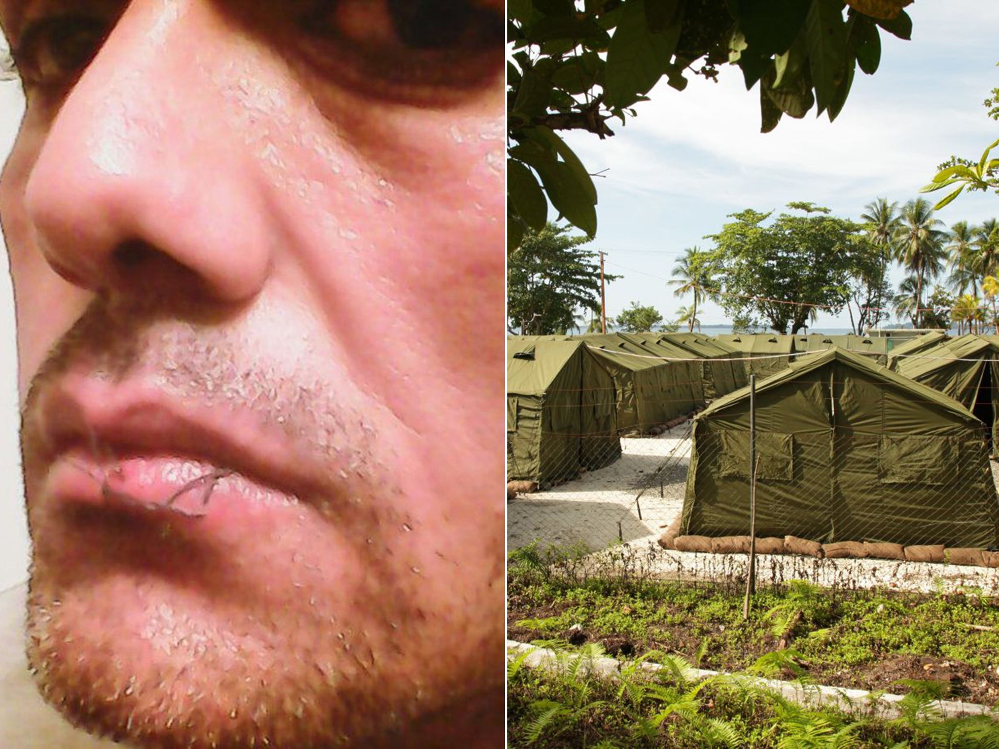 An asylum-seeker in Papua New Guinea has sewn his lips together in protest at his detention on Manus Island, right (Getty)