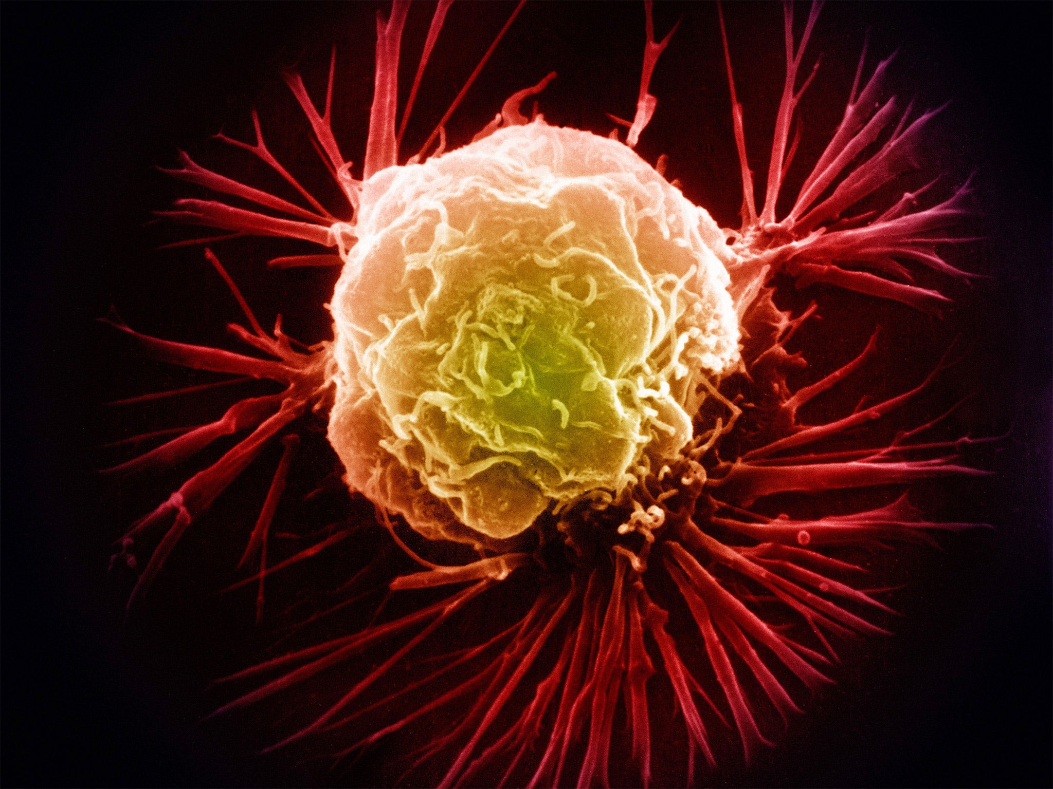 The immune system tries to fight cancer with T cells but usually loses the battle