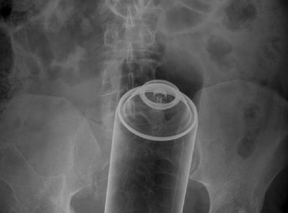 Most Unusual X Rays Radiopaedia Cases Show Deodorant Cans Coffee Jars And Other Foreign