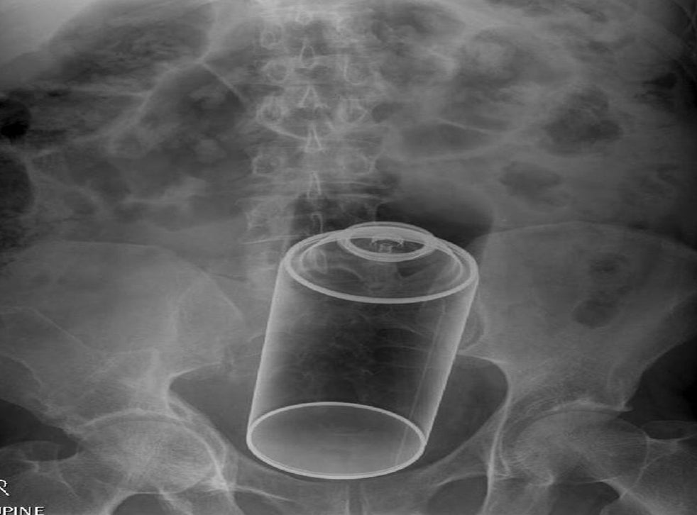 Most unusual Xrays Radiopaedia cases show deodorant cans, coffee jars