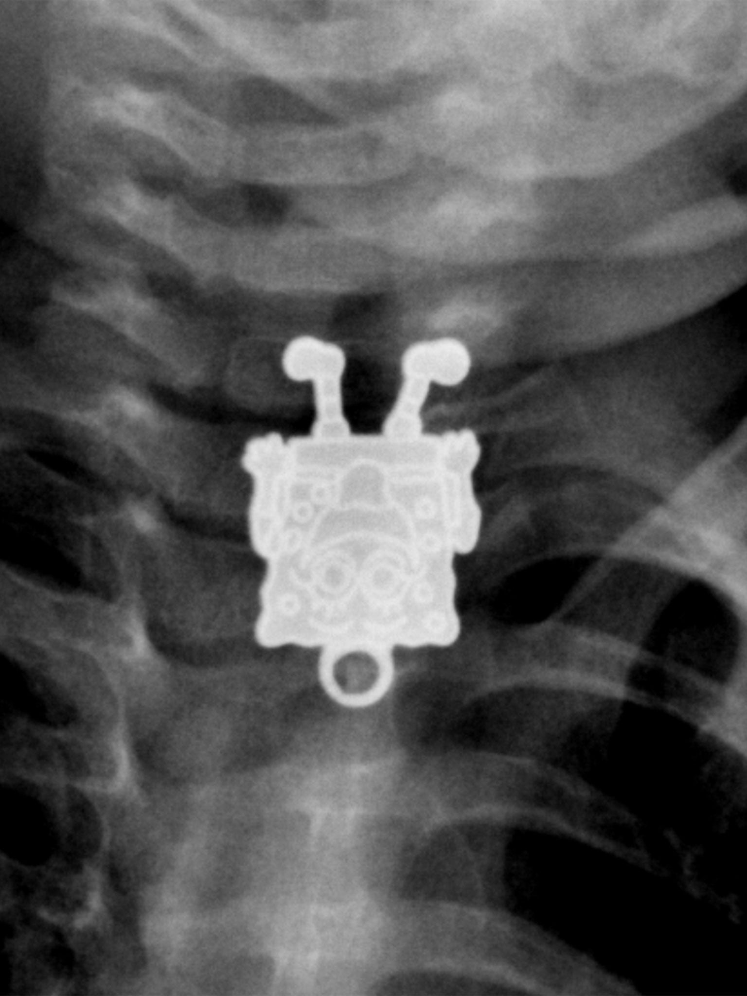 Рентген инородное тело в ЖКТ