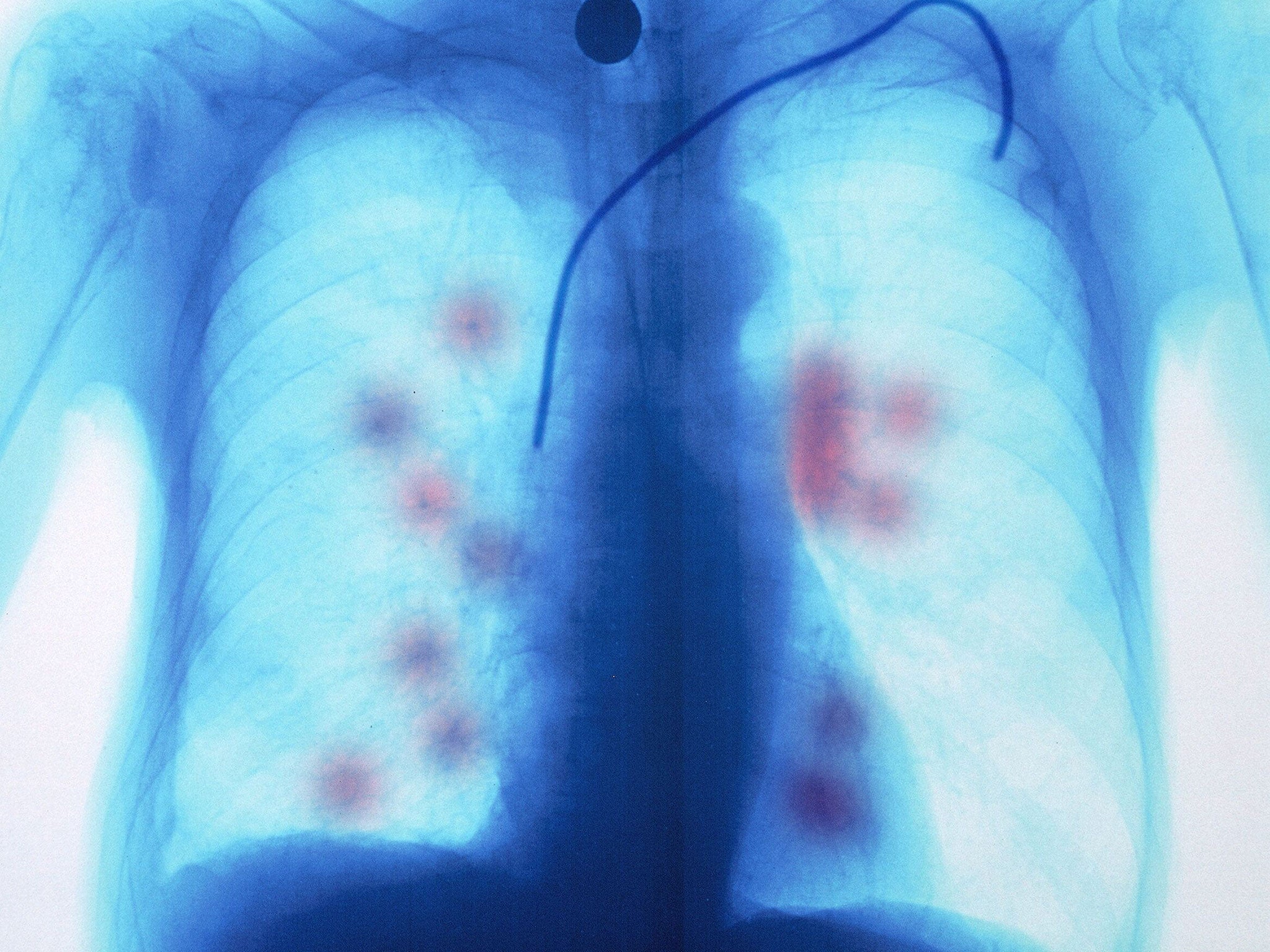 Secondary lung cancer. The Lung Cancer Indicator Detection (LuCID) device could be made available to GPs within the next two years