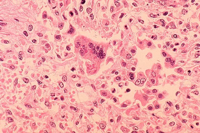 Spot the difference: tissue from a patient suffering with measles-associated pneumonia