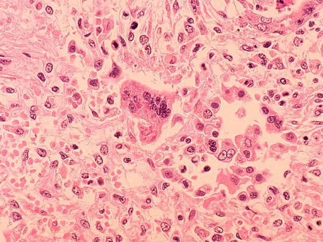 Spot the difference: tissue from a patient suffering with measles-associated pneumonia