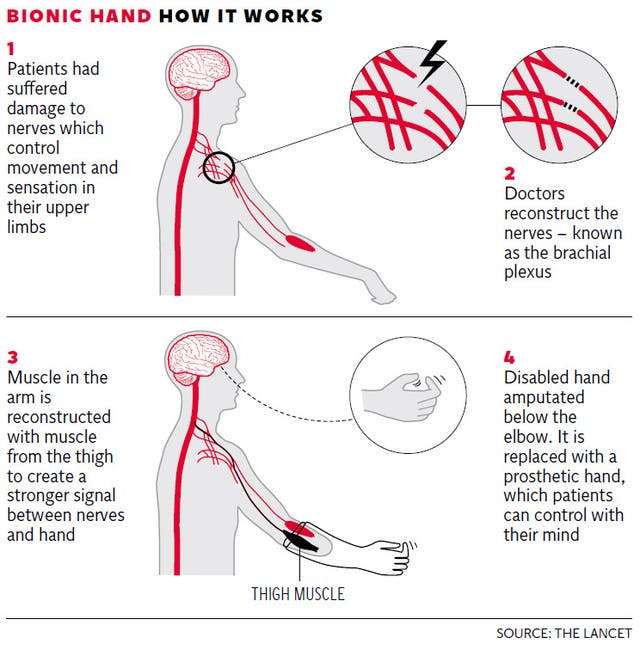 Bionic hands: Disabled limbs replaced with mind-controlled prosthetics ...