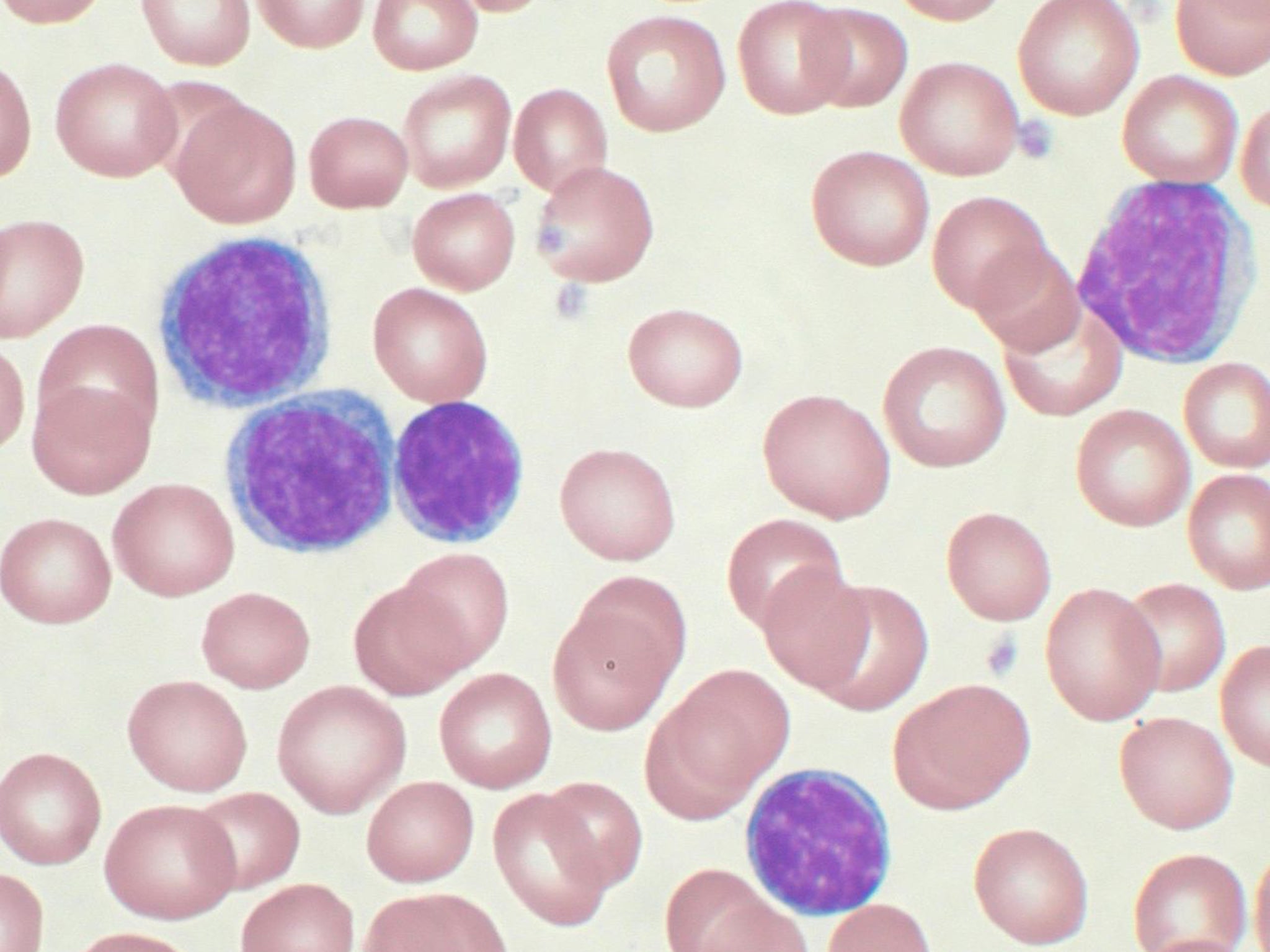 Over 20 per cent of people between 50 and 60 have blood cells marked with the same DNA mutations found in leukaemia cells