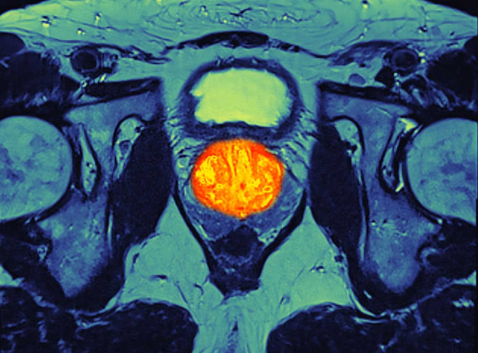 Magnetic resonance imaging (MRI) scan of the pelvic region of a man with prostate cancer (orange at centre)