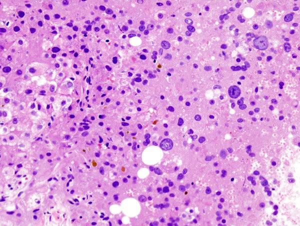 Histopatholgical image of hepatocellular carcinoma in a patient with liver cirrhosis by chronic hepatitis C infection