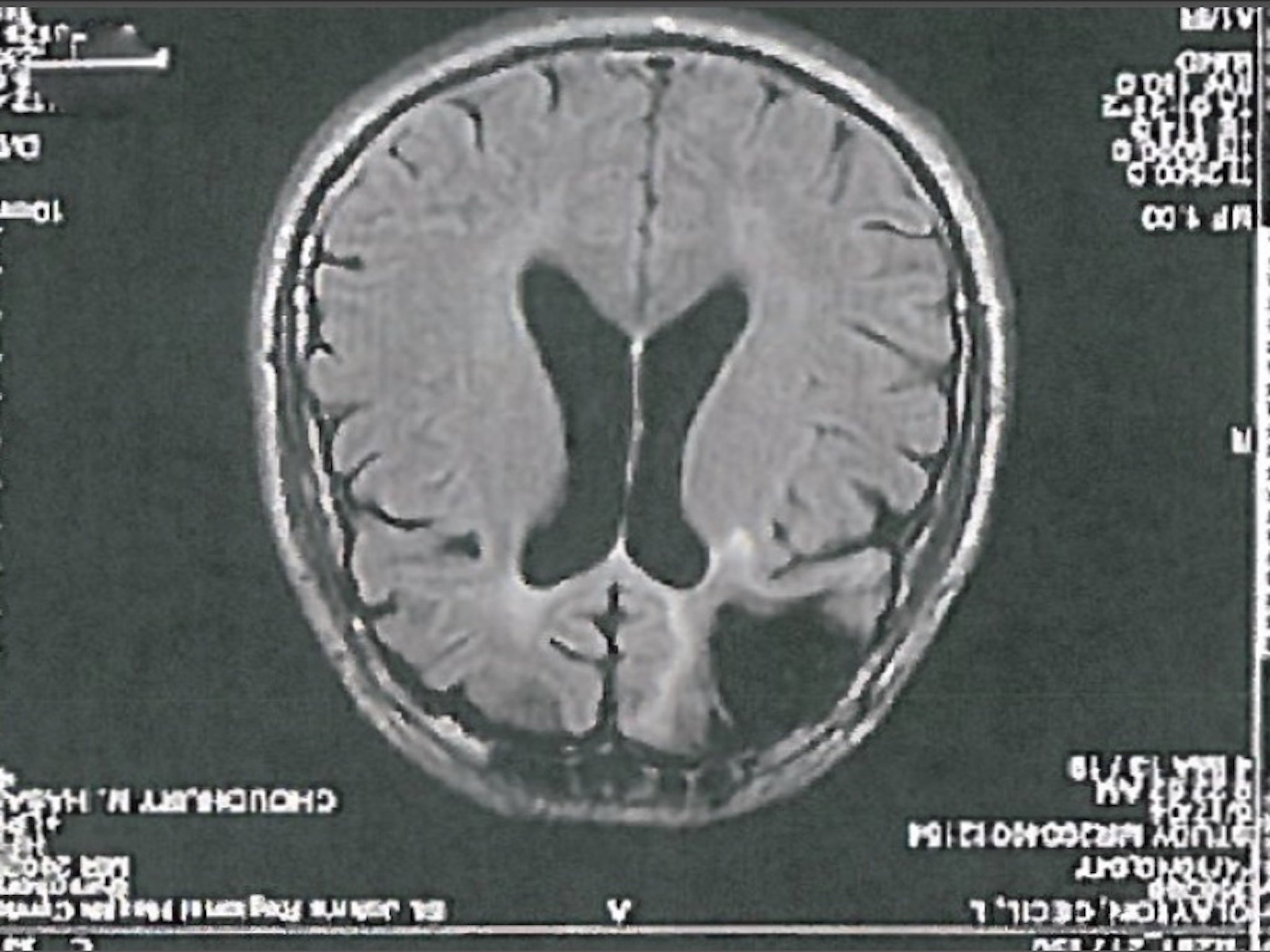 A scan of the brain Cecil Clayton's brain, which was damaged 40 years ago