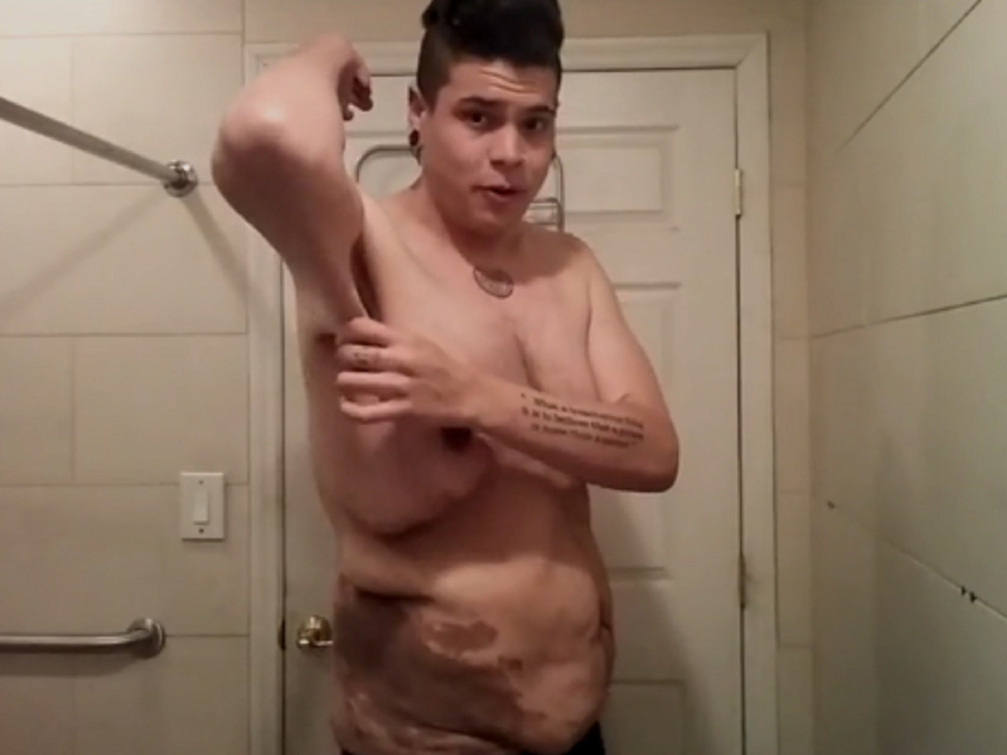 Matt Diaz was left with unwanted saggy skin after losing more than half of his body weight