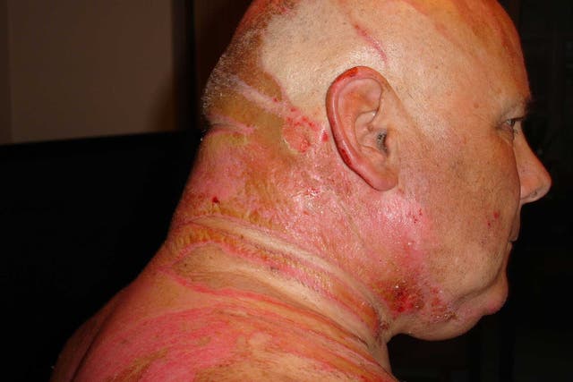 After being attacked by his wife with hot water, Ken Gregory suffered 14 per cent burns to his body