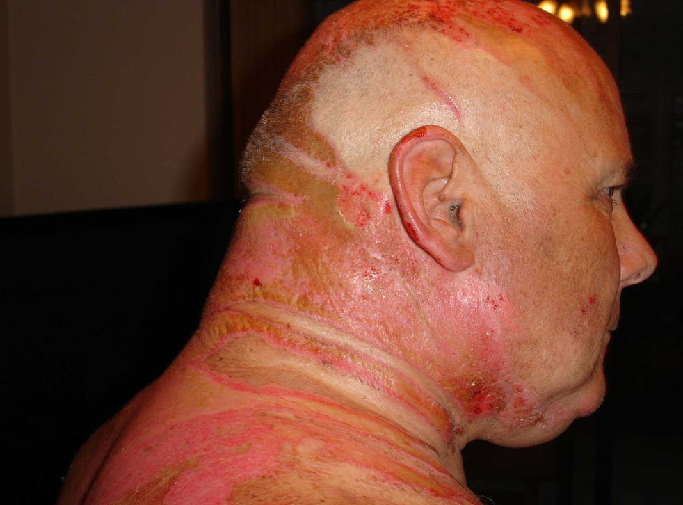 After being attacked by his wife with hot water, Ken Gregory suffered 14 per cent burns to his body