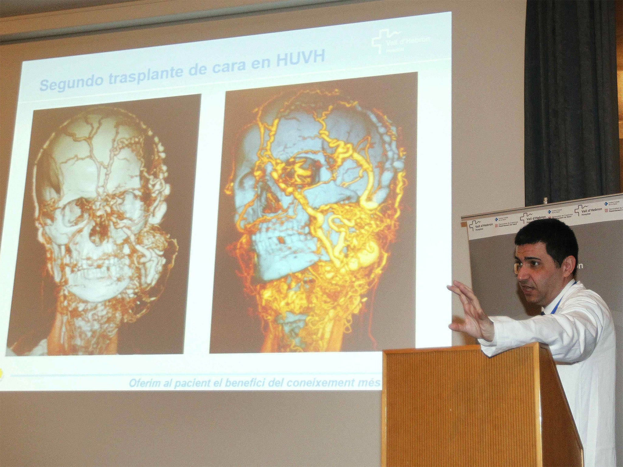 Doctor Joan-Pere Barret, chief of the Plastic Surgery and Burn Reconstruction department at the Vall d'Hebron hospital in Barcelona, explains the hospital's second face transplant