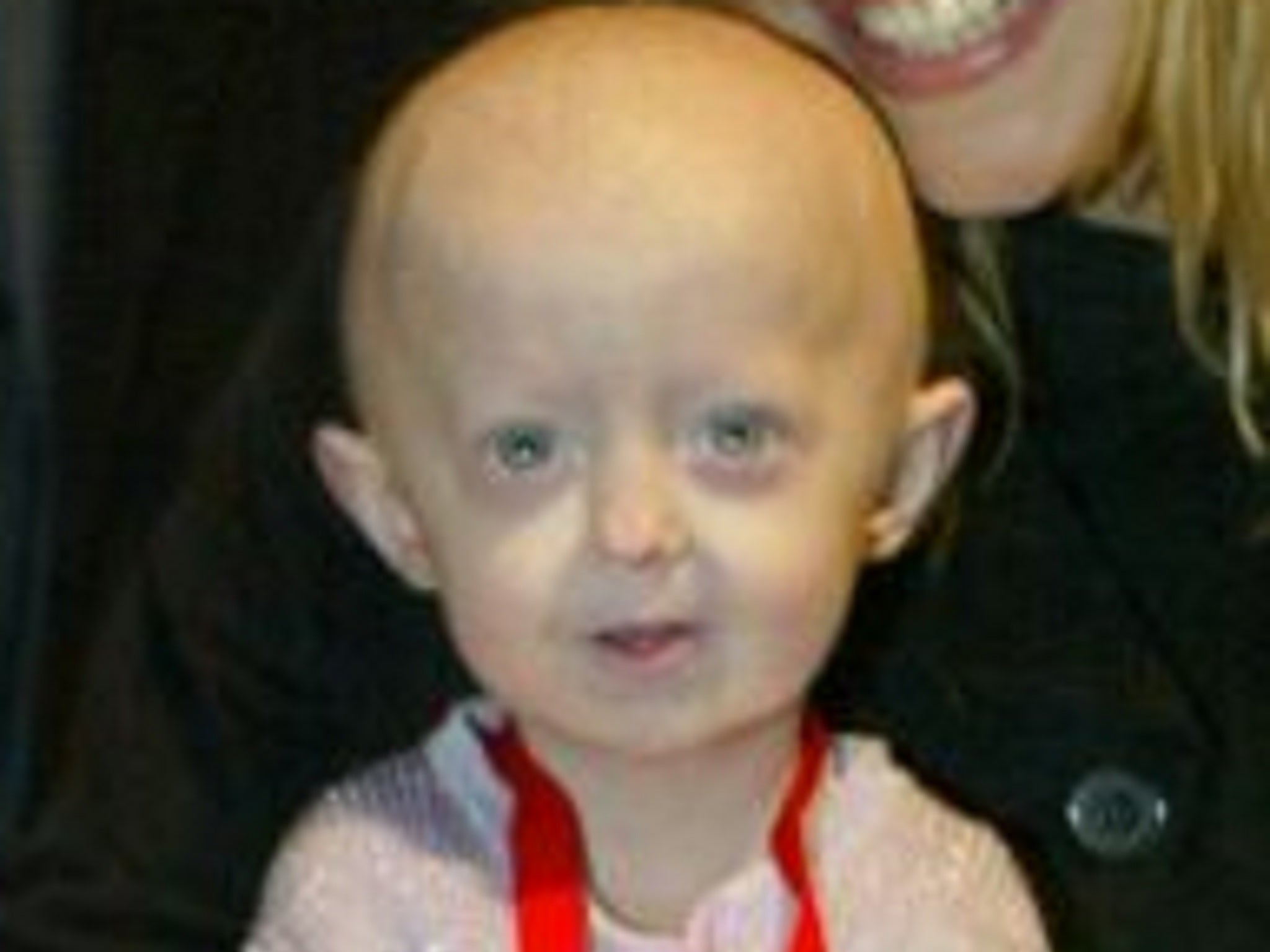 Hayley Okines, who had progeria and died aged 17 from pneumonia, was expected to only live until the age of 13