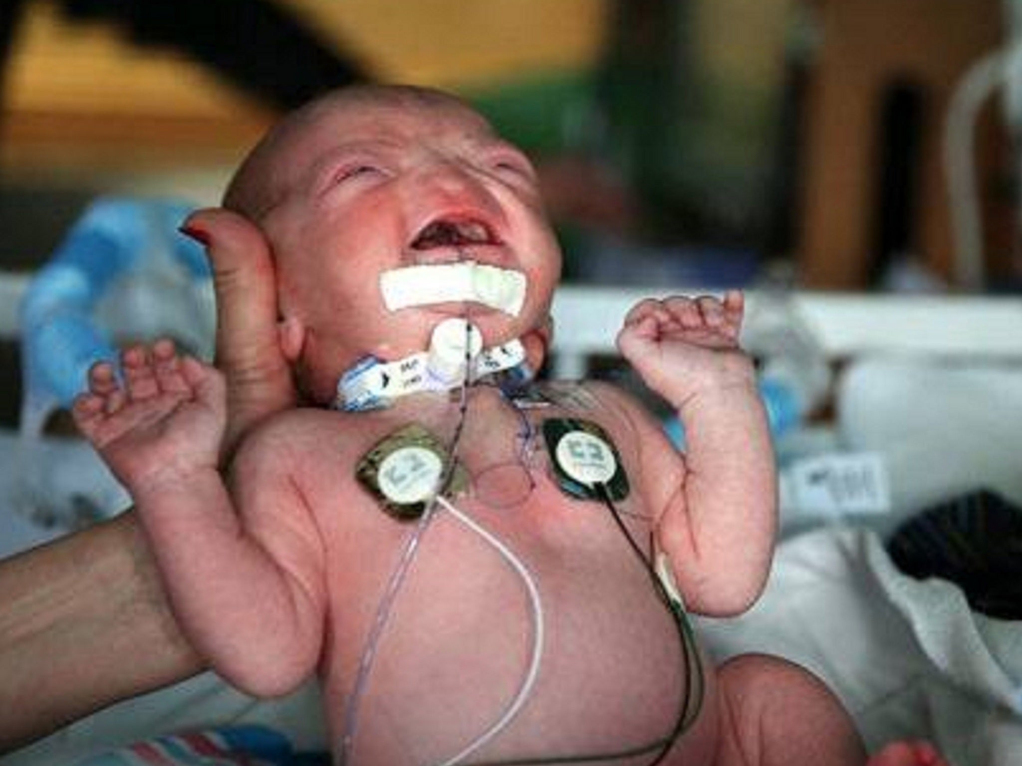 Timothy Eli Thompson was born three weeks premature without a nose
