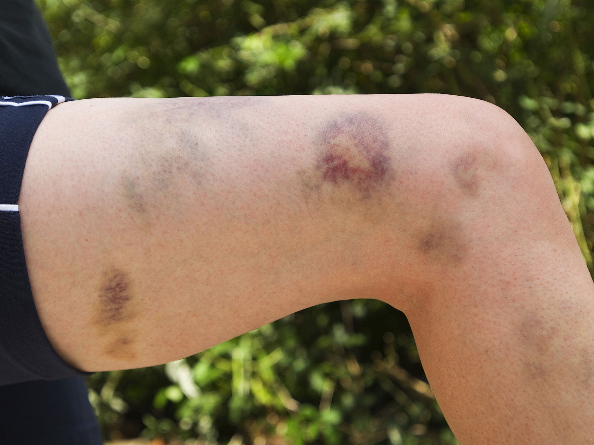 World Haemophilia Day Parents avoid Reporting Strange Bruises To 