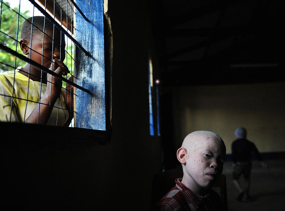 Albinos are often the victims of discrimination in Tanzania (TONY KARUMBA/AFP/Getty Images)