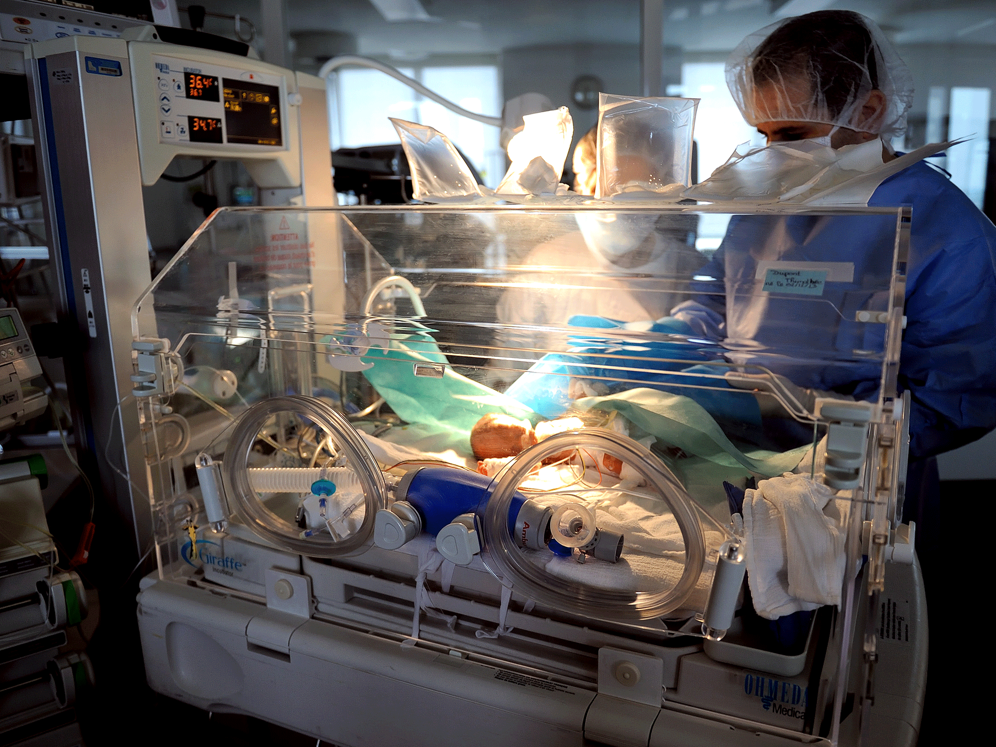 A premature baby is treated in an intensive care unit