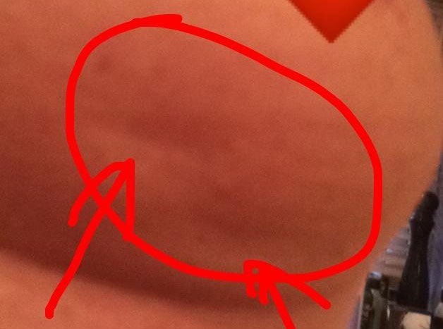 Lisa Royle posted his picture of her breast on Facebook to urge other women to check themselves
