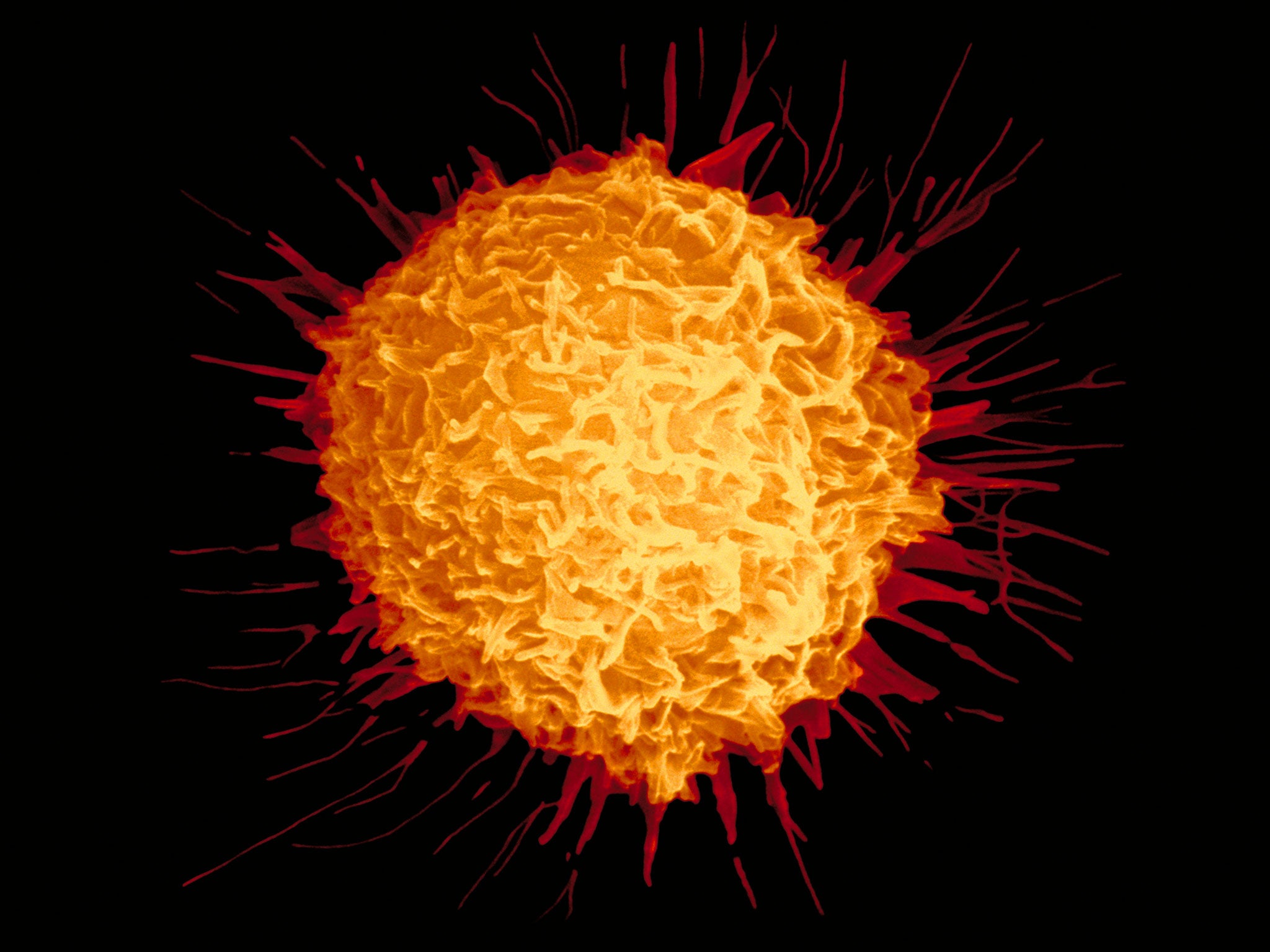 Coloured scanning electron micrograph (SEM) of a cancerous prostate cell