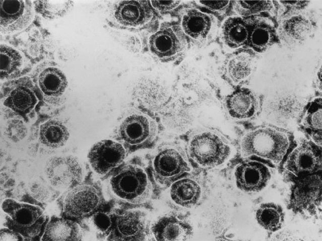 Micrograph of a herpes simplex virus