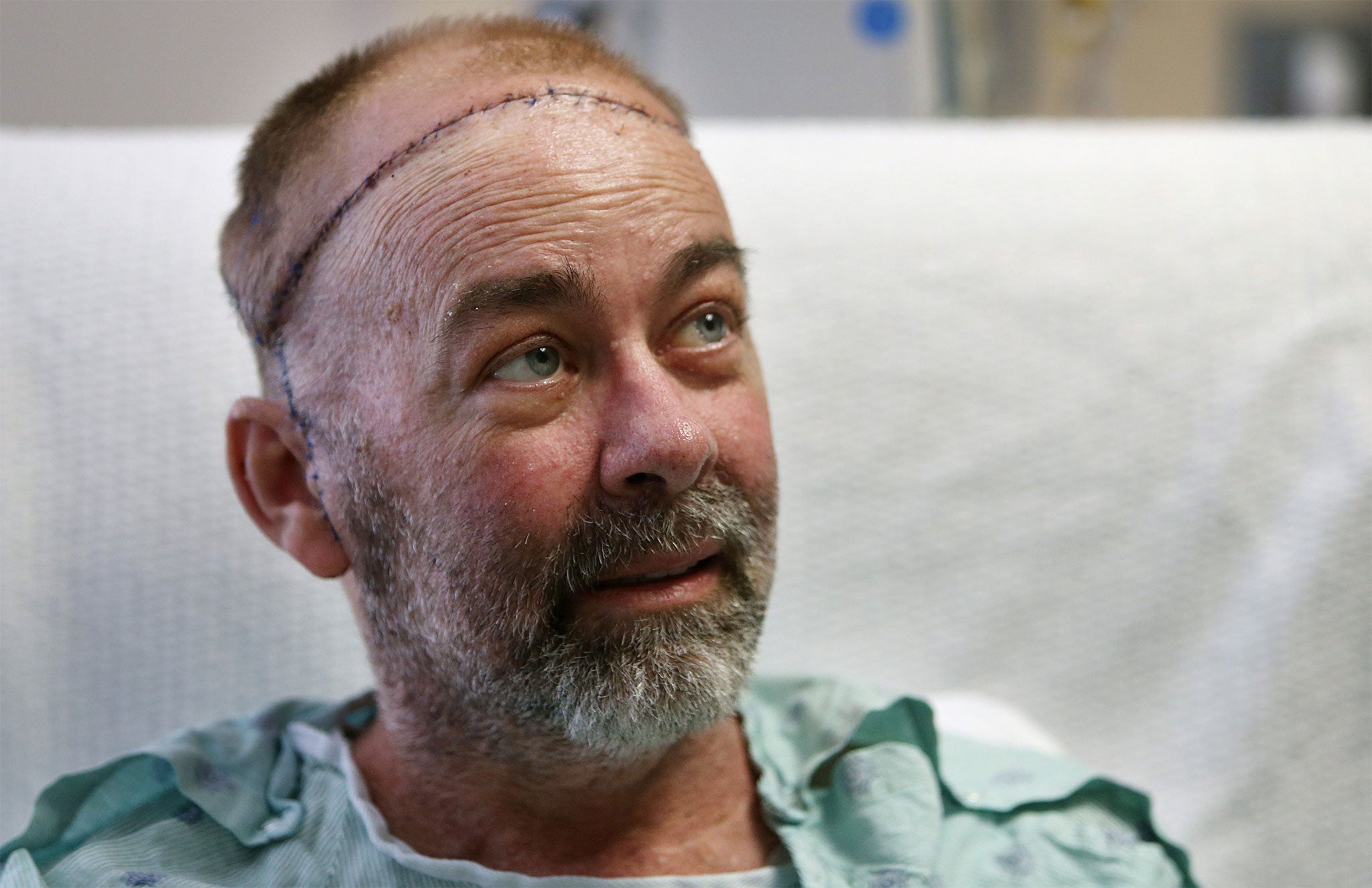 Jim Boysen was left with a large head wound from cancer treatment