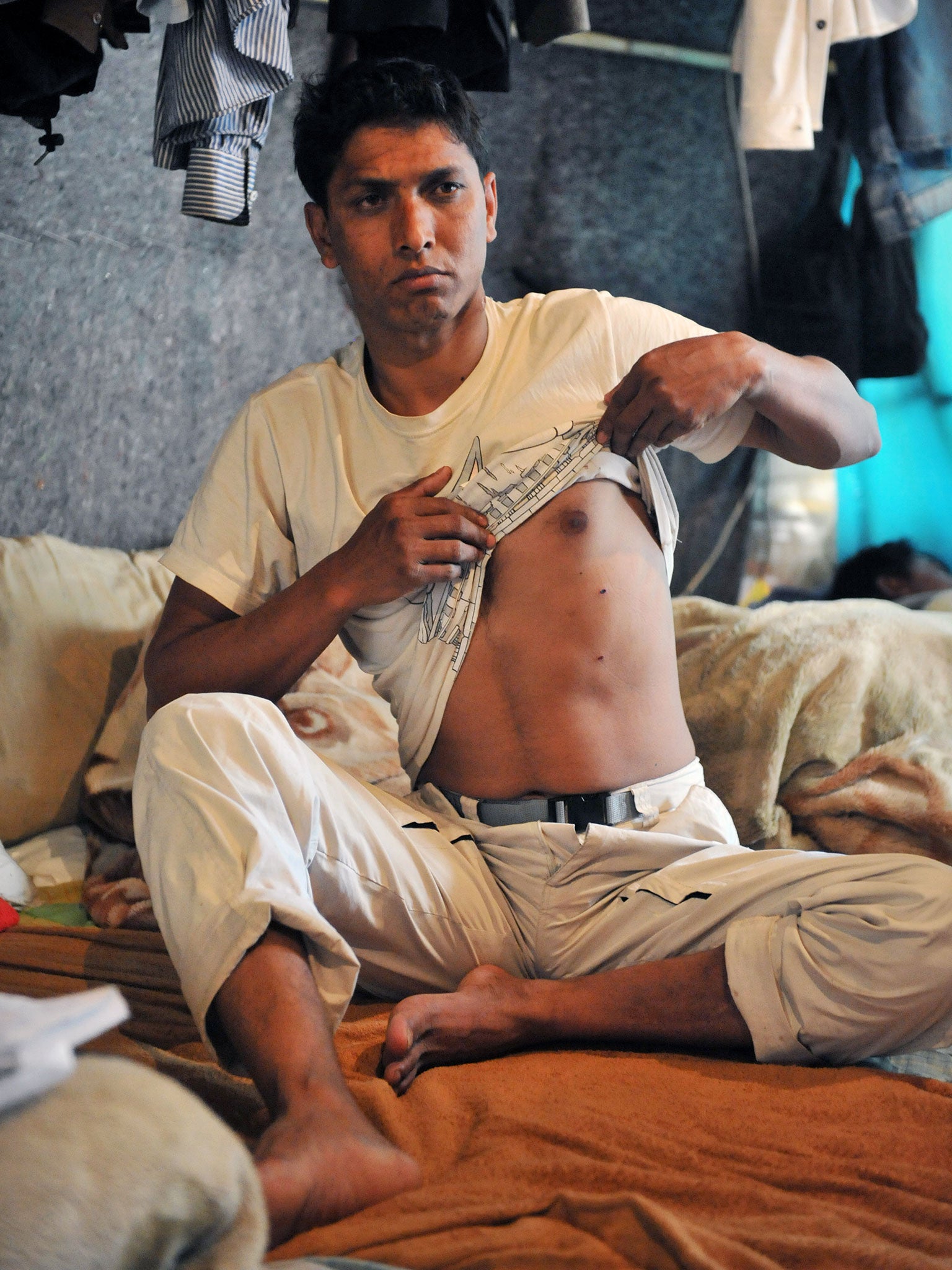 A migrant worker shows his wounds inside a makeshift camp in Nea Manolada