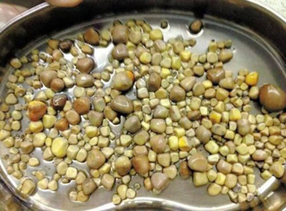 man-in-china-has-420-kidney-stones-removed-as-a-result-of-excessive