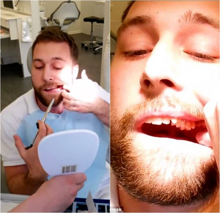 Danish dental student pulls out own wisdom tooth and