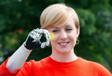 British woman receives world's most lifelike bionic hand