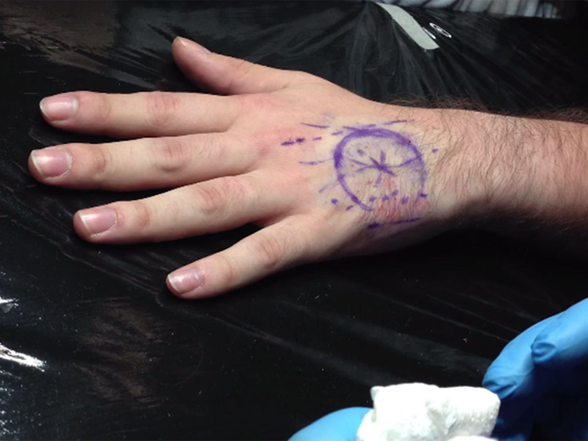 Vlad Zaitsev's hand before the operation (Image: YouTube/Madrobots.Ru)