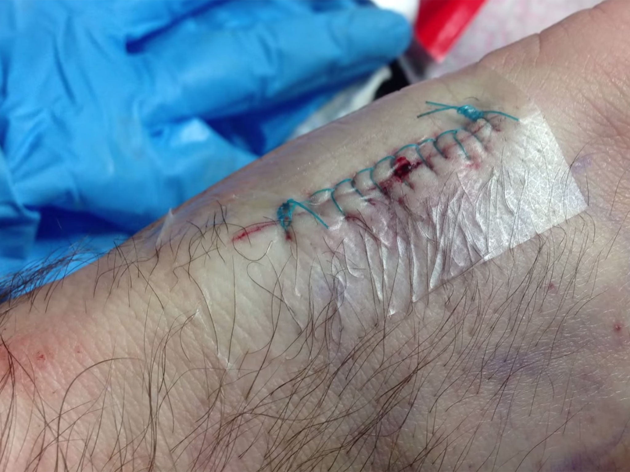 The scar Vlad Zaitsev was left with after implanting his travel card into his hand