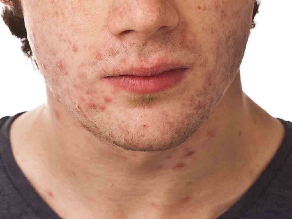 on face in of pimples adults Causes