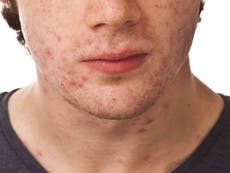 Adult acne: Causes, myths and treatments