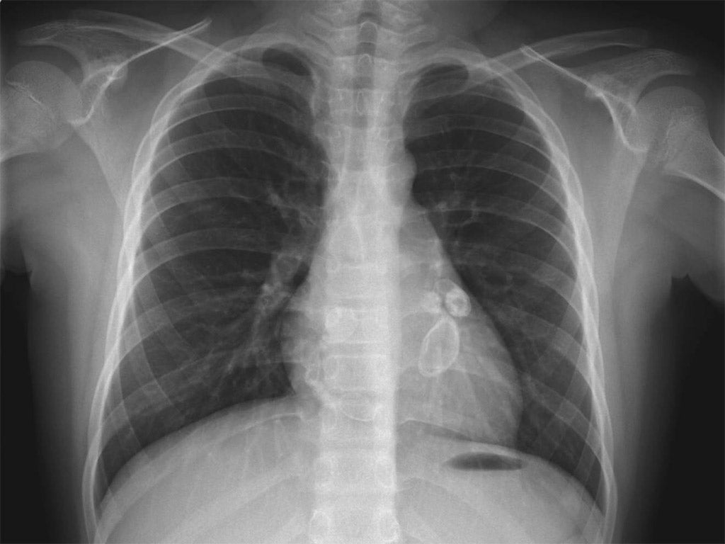 X-ray showing aneurysmal enlargement of the coronary arteries, which is a complication in a Kawasaki syndrome