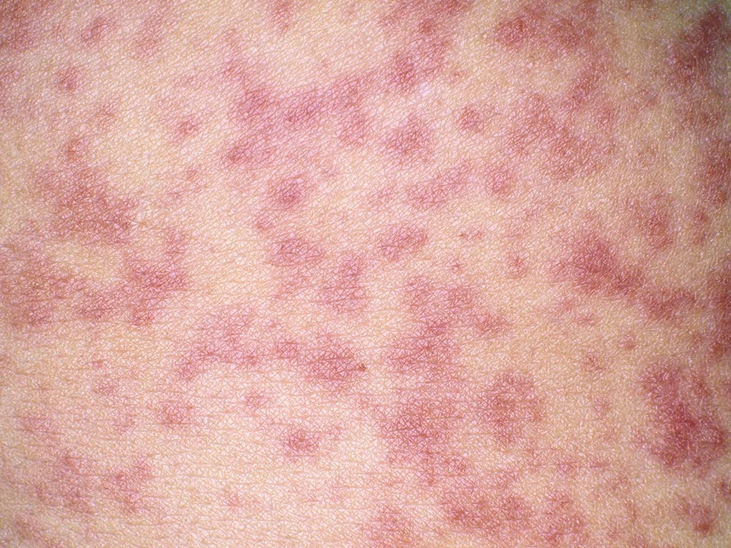 Skin rash from an allergic reaction to laundry detergent.