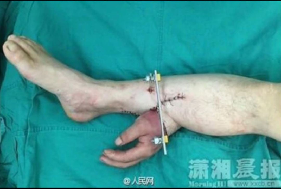The surgery in Hunan province, China was to enable the arm to heal before the hand was reattached