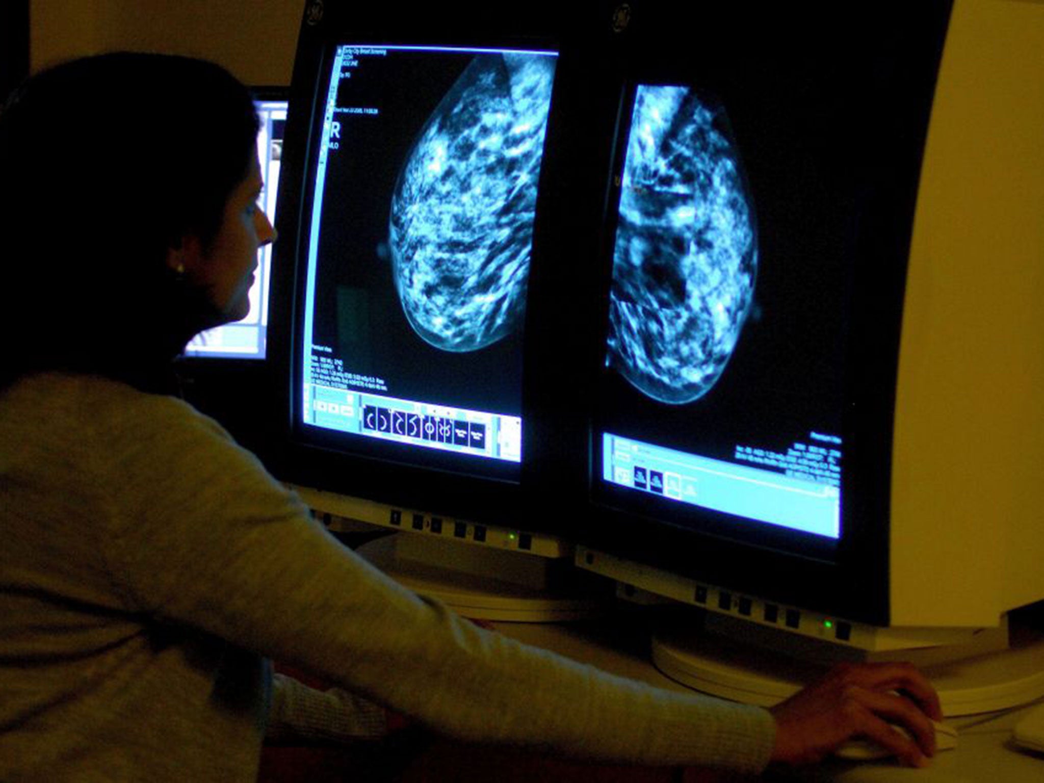 A consultant analysing a mammogram showing a woman's breast in order check for breast cancer